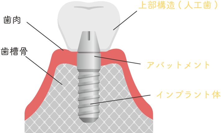 インプラントの構造