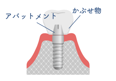 一次手術イラスト