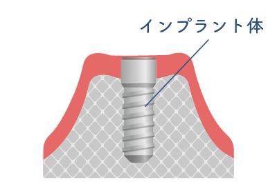 治療期間イラスト