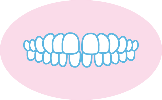 空隙歯列