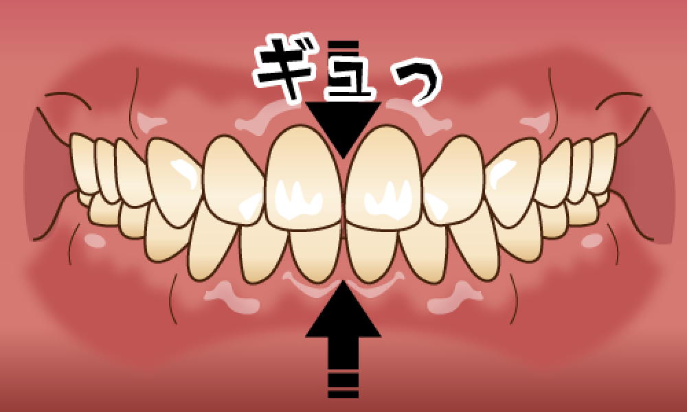 井ビシ歯科医院　歯ぎしり　クレンチング