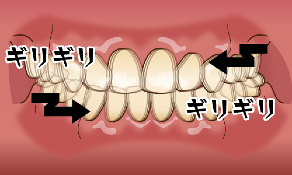 井ビシ歯科医院　歯ぎしり　グラインディング