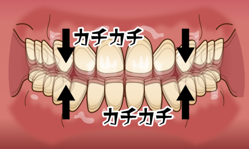 井ビシ歯科医院　歯ぎしり　タッピング