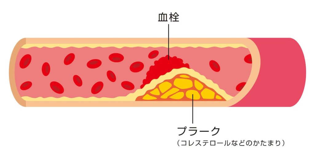 動脈硬化