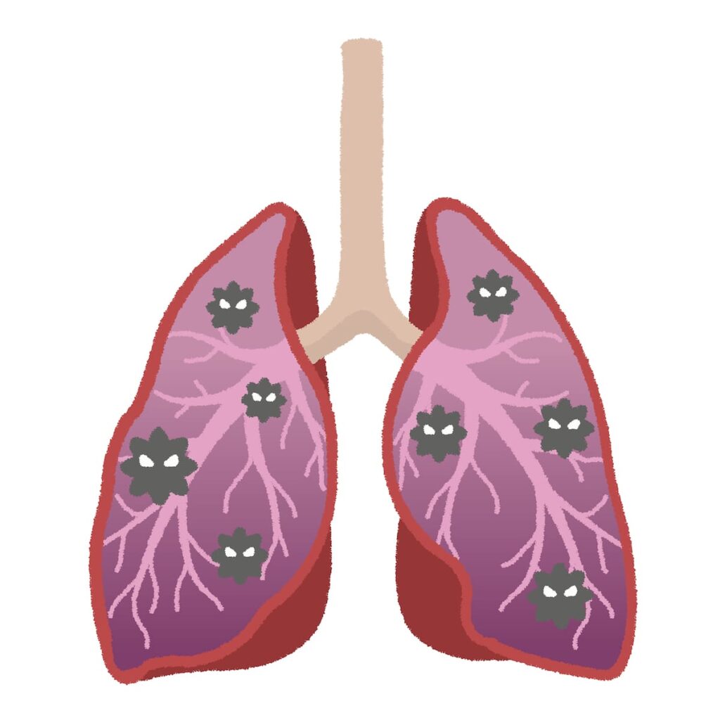 肺炎　ウイルス