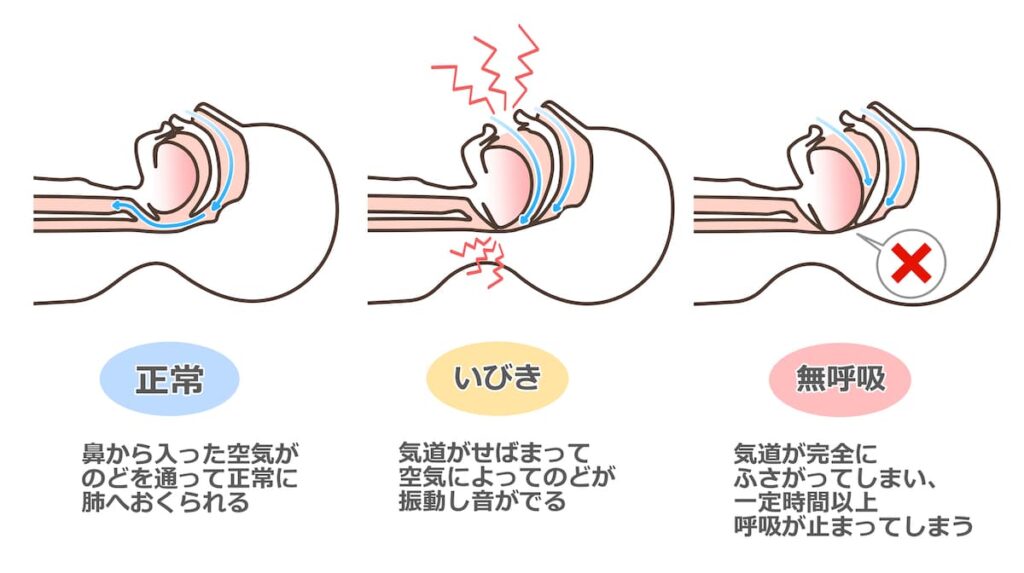 睡眠時無呼吸症候群